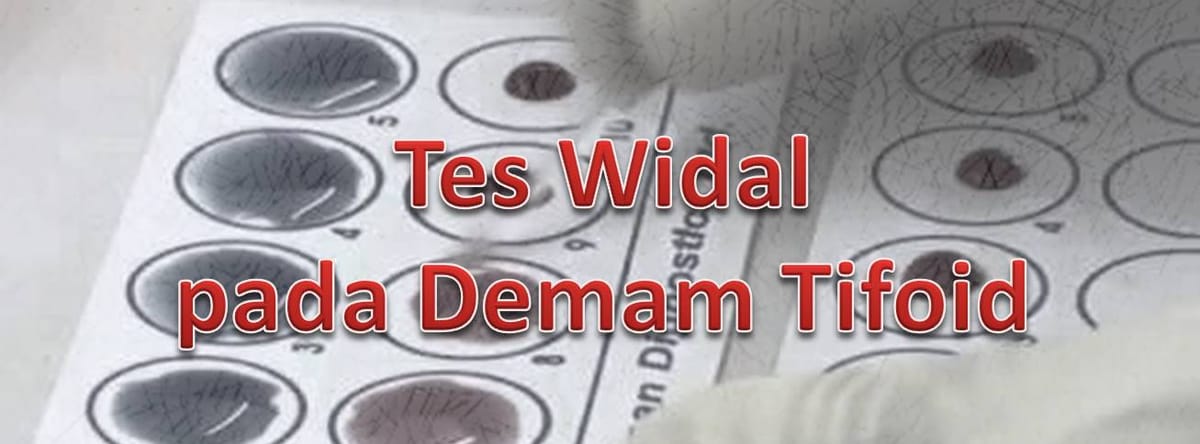 Penggunaan Tes Widal pada Diagnosis Demam Tifoid