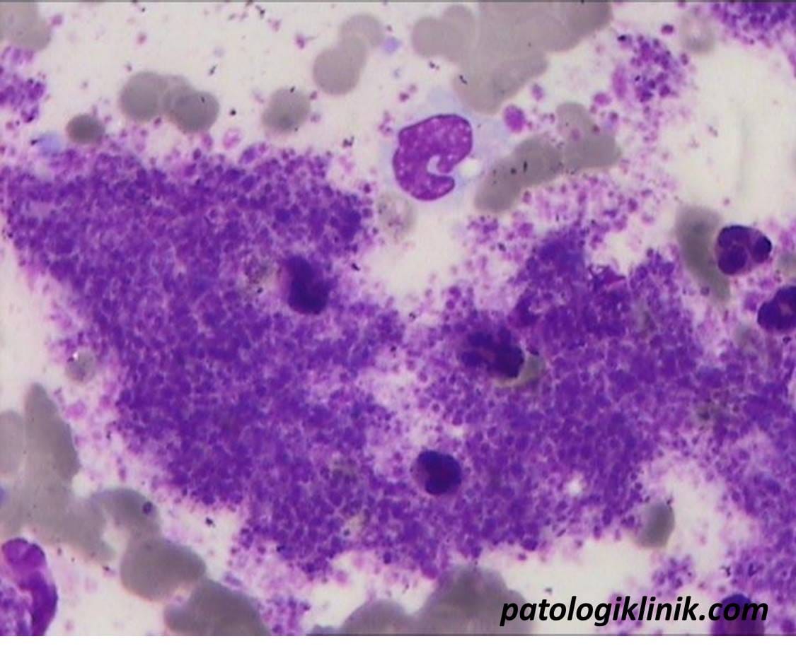 Essential Thrombocytemia