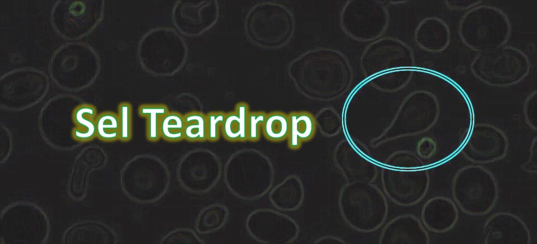 Sel Teardrop atau Dacrocyte